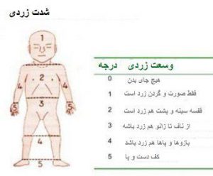 شدت زردی نوزاد
